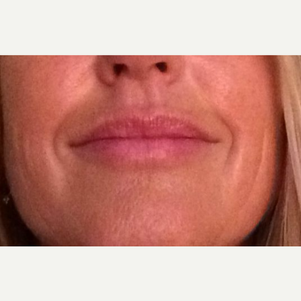 35-44 year old woman treated with Lip Augmentation after 3460114