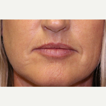 35-44 year old woman treated with Lip Augmentation before 3460114