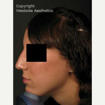 Non Surgical Nose Job With Permanent Filler after 3004800