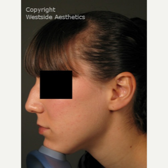 Non Surgical Nose Job With Permanent Filler before 3004800