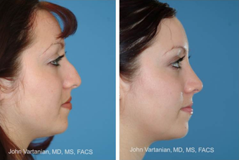 25-34 year old woman treated with Rhinoplasty after 3810049