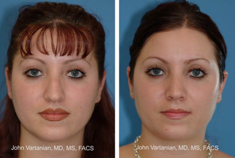 25-34 year old woman treated with Rhinoplasty before 3810049