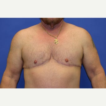 61 year old man treated with FTM Chest Masculinization Surgery after 1919018