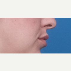 25-34 year old woman treated with Restylane Silk after 3764267