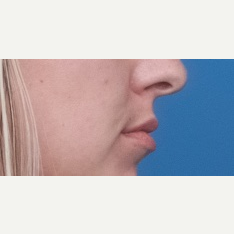 25-34 year old woman treated with Restylane Silk before 3764267