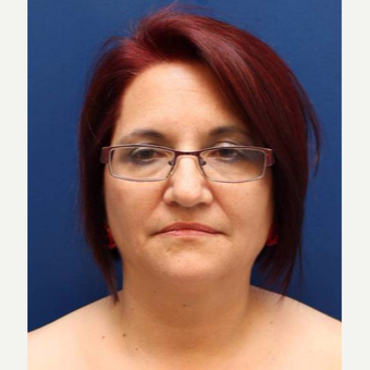 57 year old female, SMAS plication facelift before 3814716