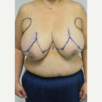 55-64 year old woman treated with Breast Reduction and liposuction of the axilla before 3383008
