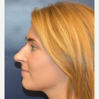 18-24 year old woman treated with Rhinoplasty before 3251915