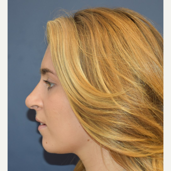 18-24 year old woman treated with Rhinoplasty after 3251915