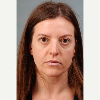 35-44 year old woman treated with Fat Transfer before 1648198