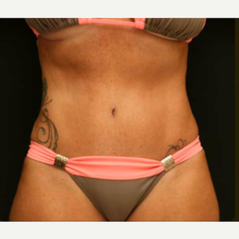 Abdominoplasty with lipo of abdomen, flanks and low back after 3529207