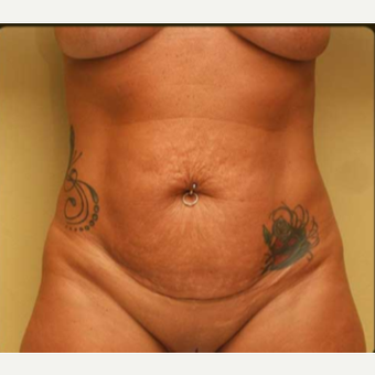 Abdominoplasty with lipo of abdomen, flanks and low back before 3529207