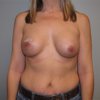 45-54 Latissimus Dorsi w/ Implant Reconstruction before 3004087