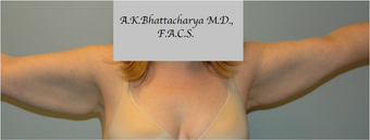 45-54 year old woman treated with Arm Lift before 3305266
