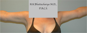 45-54 year old woman treated with Arm Lift after 3305266