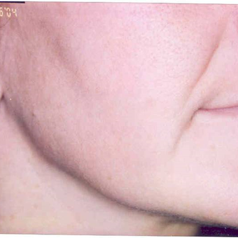 45-54 year old woman treated with TITAN after 3524134