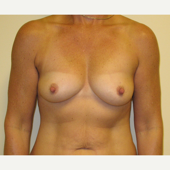 45-54 year old woman treated with Breast Reconstruction before 3041294