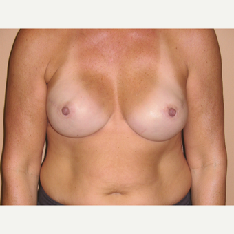 45-54 year old woman treated with Breast Reconstruction after 3041294