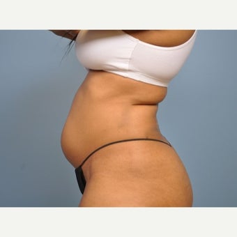 25-34 year old woman treated with Liposuction 1576084