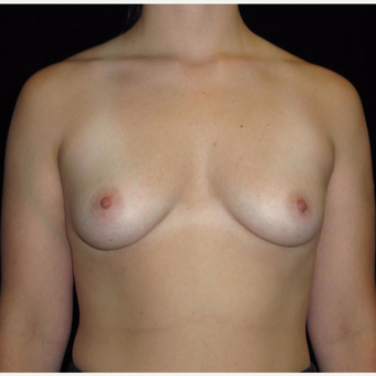26 year old woman treated with Breast Augmentation before 3802764