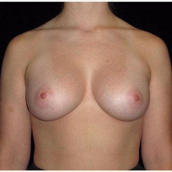 26 year old woman treated with Breast Augmentation after 3802764