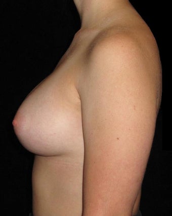 26 year old woman treated with Breast Augmentation 3802764