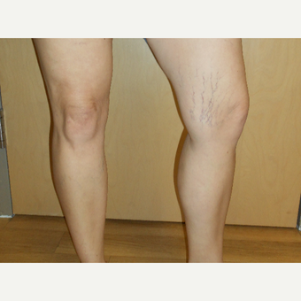 45-54 year old woman treated with Sclerotherapy before 3161507