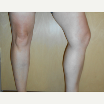 45-54 year old woman treated with Sclerotherapy after 3161507