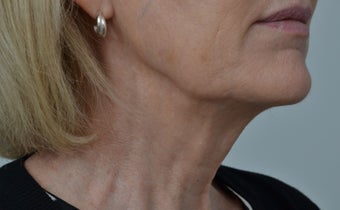 55-64 year old woman treated with Teosyal after 2970149