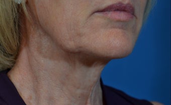 55-64 year old woman treated with Teosyal before 2970149