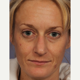 35 year old woman treated with Restylane before 3658127