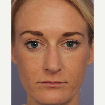 35 year old woman treated with Restylane after 3658127