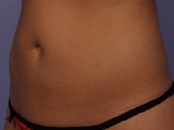 CoolSculpting by Zeltiq to Abdomen after 375538