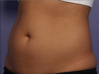 CoolSculpting by Zeltiq to Abdomen before 375538