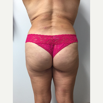 52 year old woman treated with Brazilian Butt Lift after 3682034