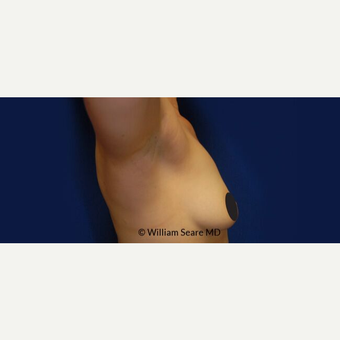35-44 year old woman treated with Breast Fat Transfer before 3803009