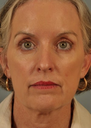 Phenol Peel after 857107