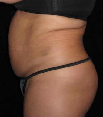 48 year old woman treated with Tummy Tuck 3656826
