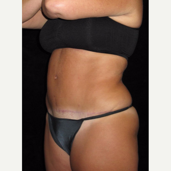 48 year old woman treated with Tummy Tuck after 3656826
