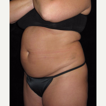 48 year old woman treated with Tummy Tuck before 3656826