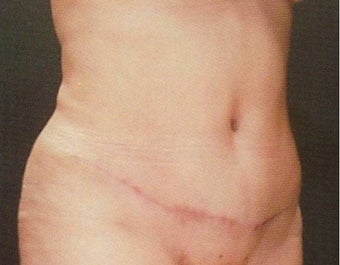 Extended full abdominiplasty with muscle repair after 849404