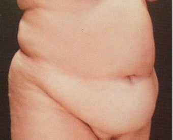 Extended full abdominiplasty with muscle repair before 849404