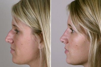 30 Year Old Female Rhinoplasty after 922542