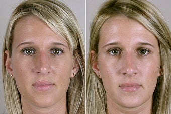 30 Year Old Female Rhinoplasty before 922542