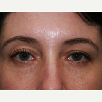 35-44 year old woman treated with Restylane after 3570840