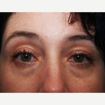 35-44 year old woman treated with Restylane before 3570840