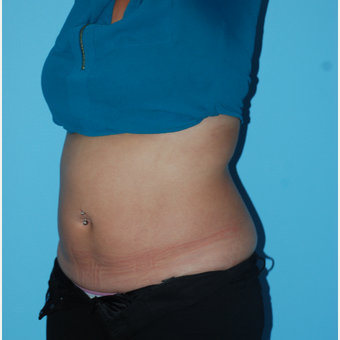 25-34 year old woman treated with SculpSure after 3065510