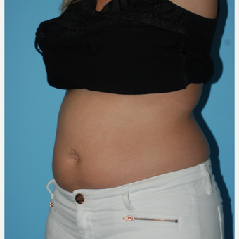 25-34 year old woman treated with SculpSure before 3065510