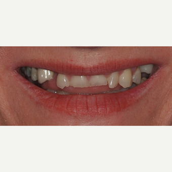 35-44 year old woman treated with All-on-4 Dental Implants before 3781247