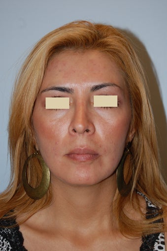 Revision Rhinoplasty after 166040